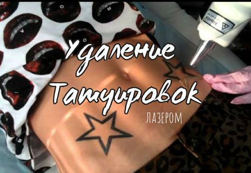 Удаление тату лазером. Осветление татуировки. Коррекция.